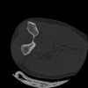 SPORK, NICO - 22.03.1976 - 02.08.2022 - CT obere Extremität - 17:51:17